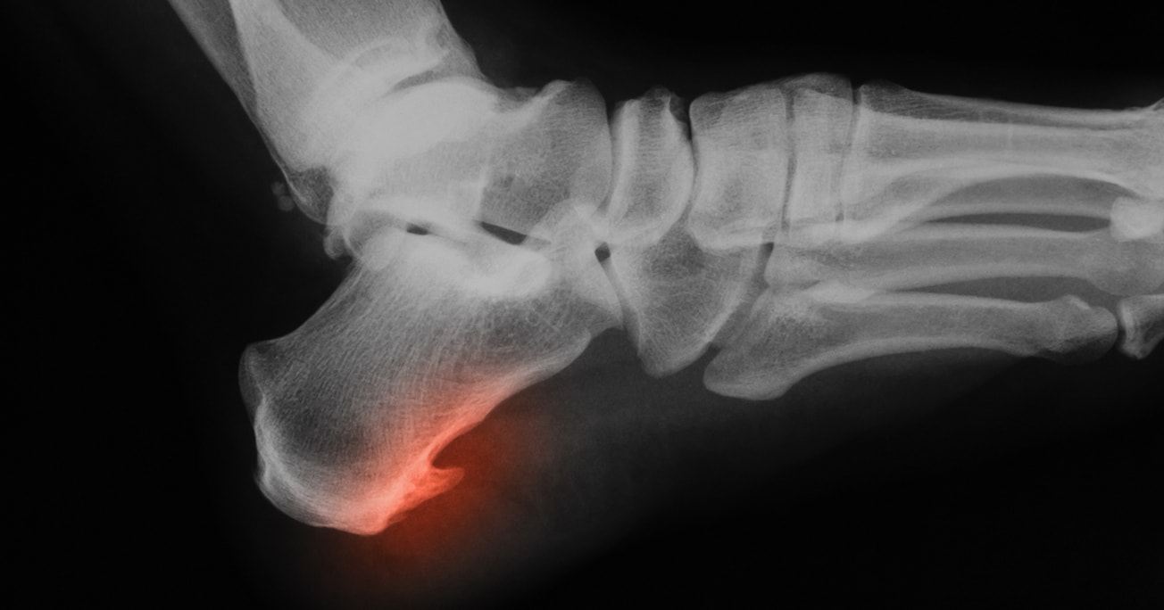 Bild von Röntgenaufnahme eines Fersensporns